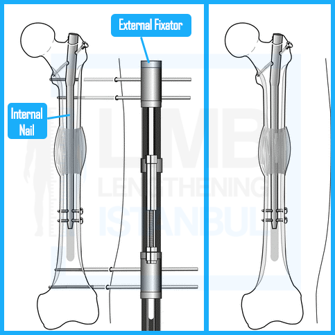 Femur External Fixator for LON Method