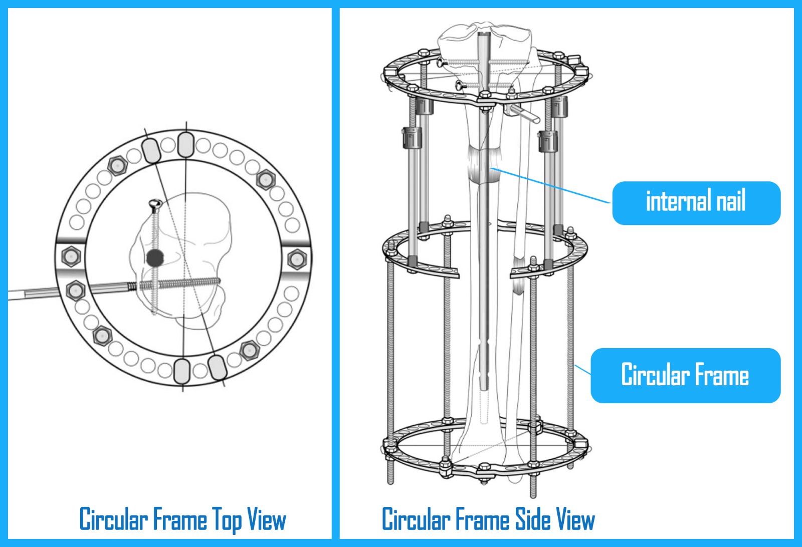 Tibia Circular External Fixator for LON Method