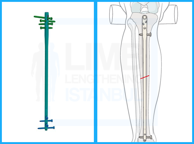 Intramedullary Nail For LON Method