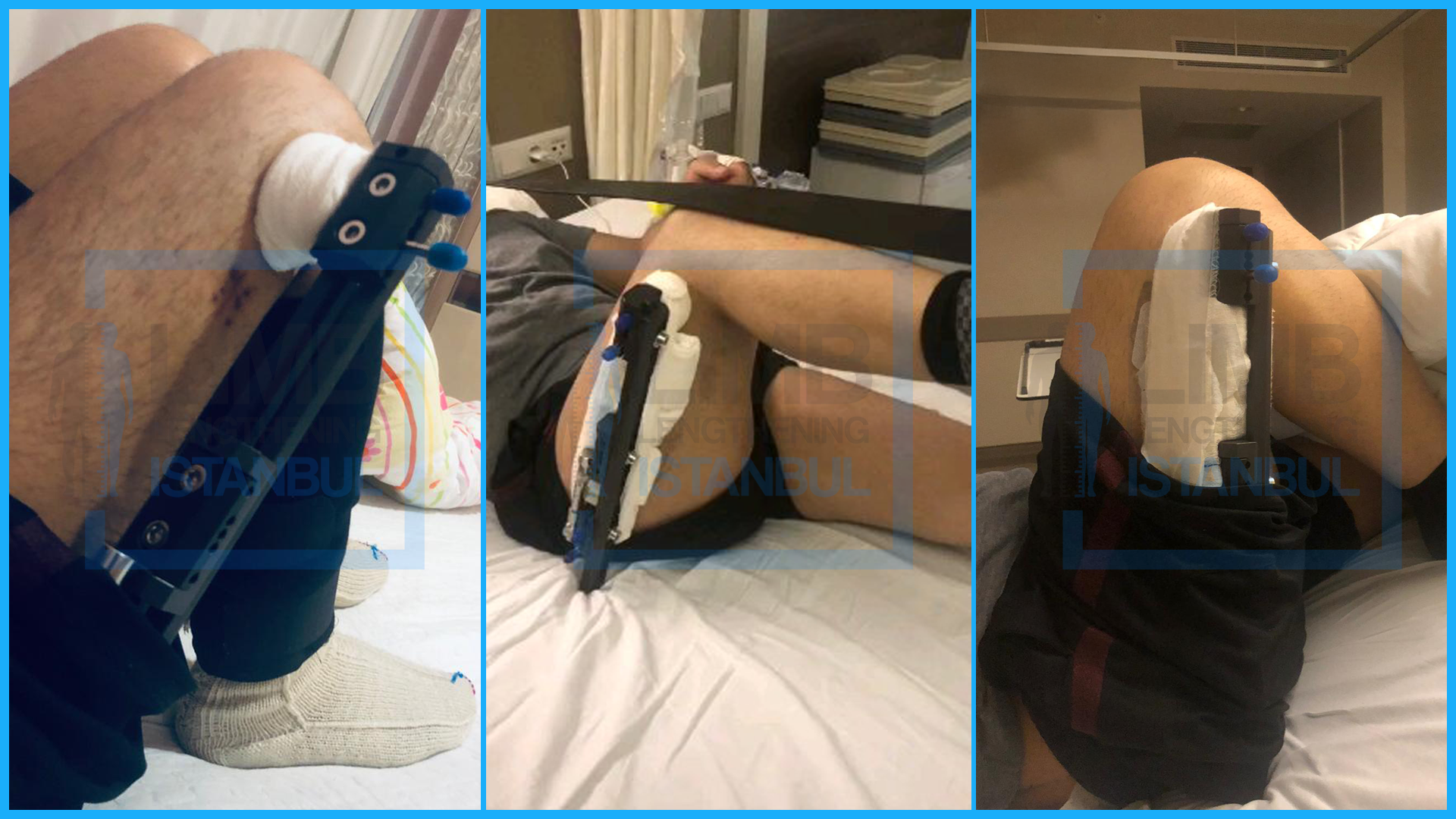 LON Method Femur Operation; Outside View of LON Femur External Fixator