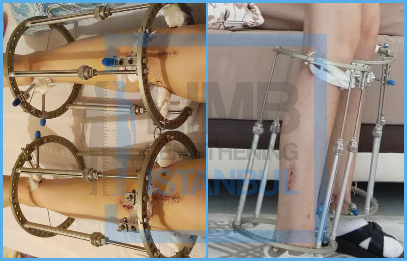 LON Method Tibia Operation; Outside View of LON Tibia External Fixator