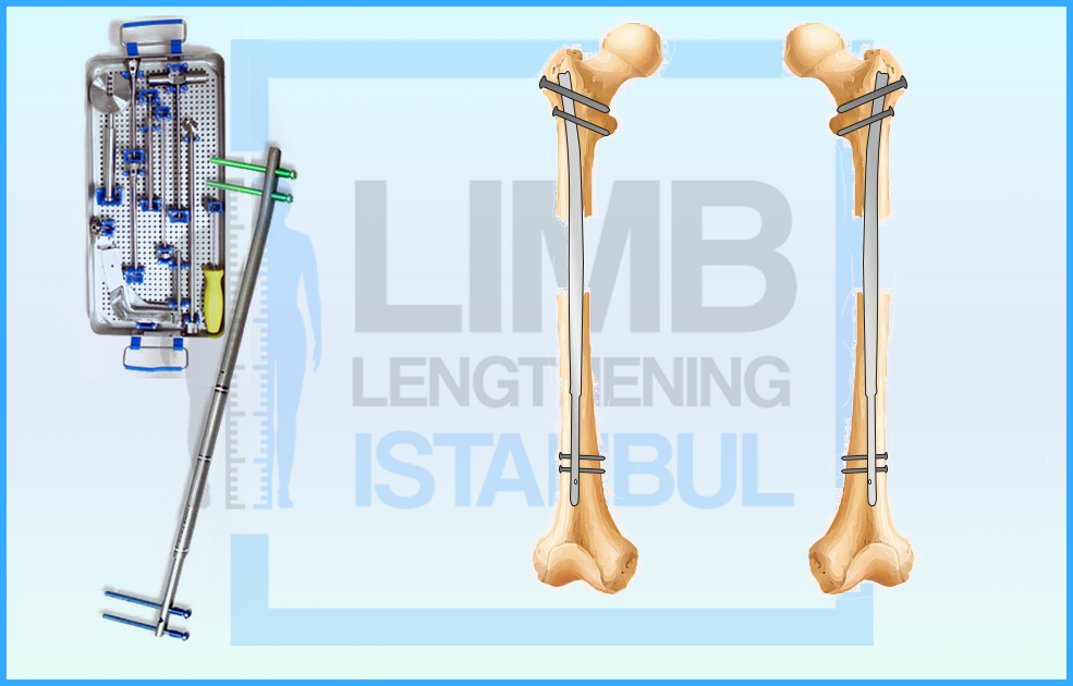 Precice 2 Method Intramedullary Nail